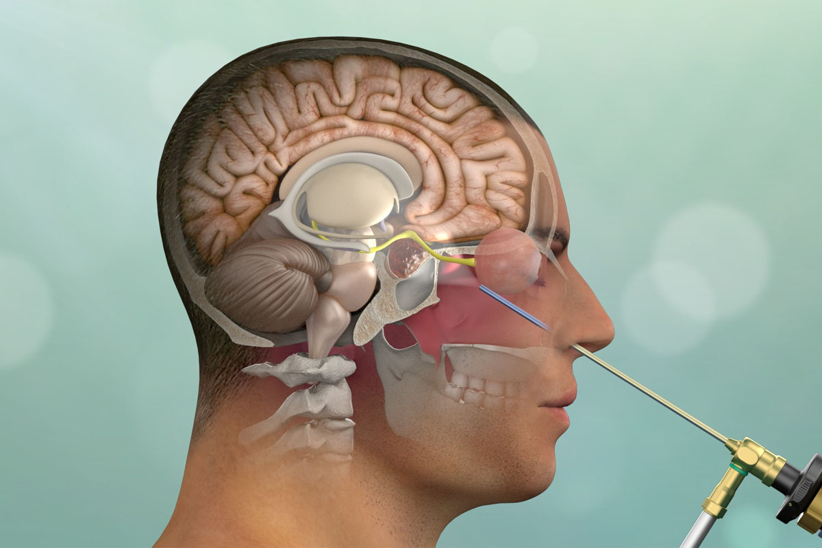 skull-base-surgery